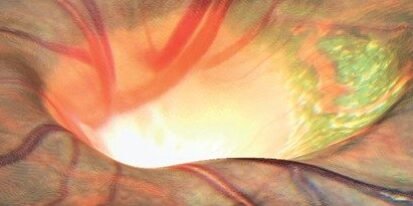 glaucoma banner
