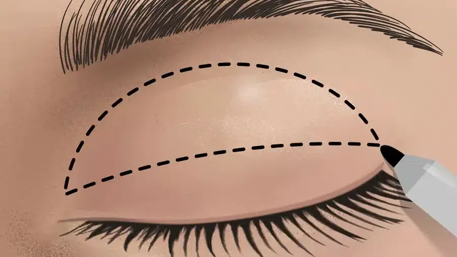 Blefaroplastica-e-oculoplastica-illustrazione